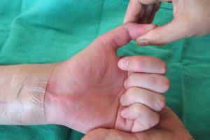 Upper Extremity Tendon Injury Update: Advances in Clinical Management (hybrid online)